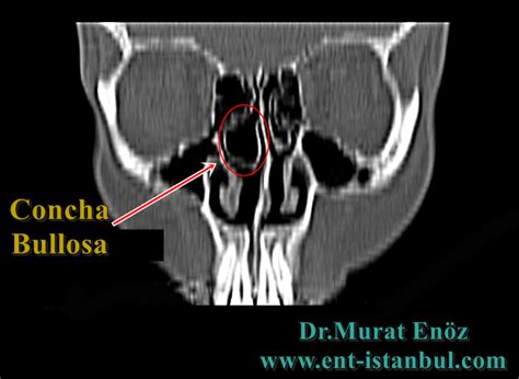 Everything You Need to Know About Concha Bullosa: Symptoms and Treatment
