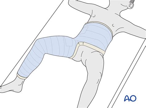 Healthcare Costs Associated With Spica Casting