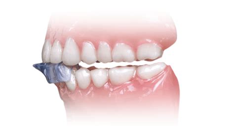 Unlock the Secrets of Nti Night Guard Comfort