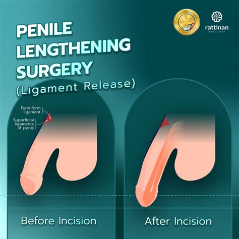 Penis Surgery Cost: What to Expect?