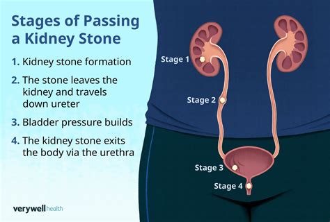 Stages of Passing a Kidney Stone Explained Simply