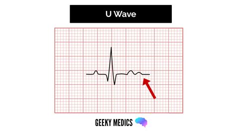 Unlocking the Mystery of U Wave ECG